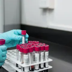 Badanie D-dimerów: co to jest i dlaczego jest tak ważne w diagnostyce?