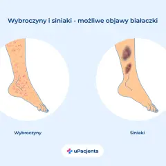 Wybroczyny i siniaki na nogach mogą być objawami białaczki. Ilustracja pokazuje zmiany skórne.