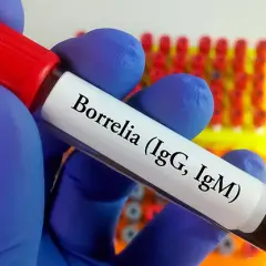 Jak przygotować się do badania na boreliozę, aby uniknąć błędów