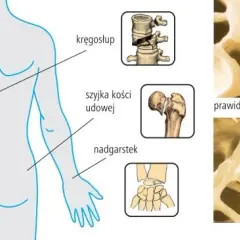 Osteoporoza jakie badania krwi są kluczowe dla diagnozy i zdrowia?