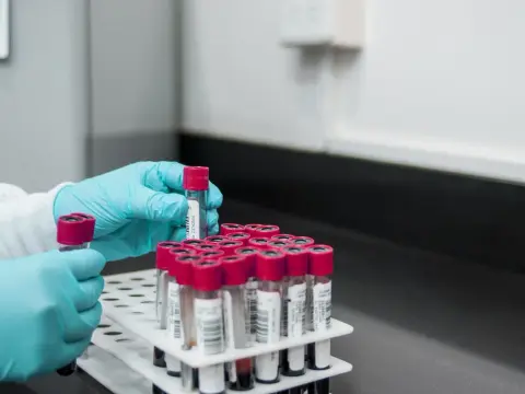 Badanie D-dimerów: co to jest i dlaczego jest tak ważne w diagnostyce?
