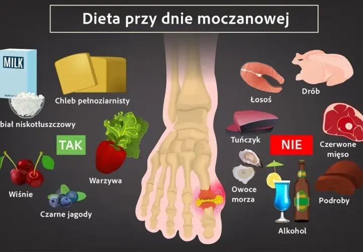 Dieta przy dnie moczanowej: TAK - nabiał, warzywa, owoce. NIE - czerwone mięso, podroby, alkohol. Milurit co to za lek? Zapytaj lekarza.
