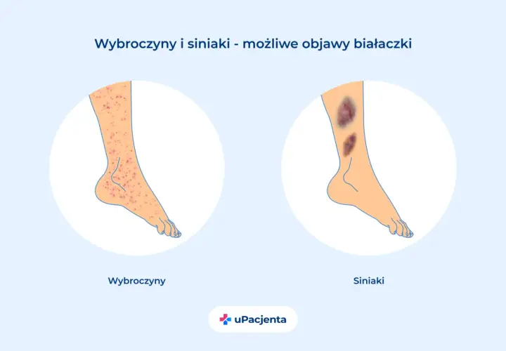 Wybroczyny i siniaki na nogach mogą być objawami białaczki. Ilustracja pokazuje zmiany skórne.