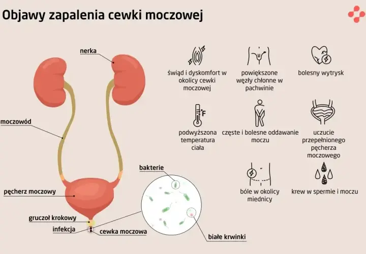 Objawy zapalenia cewki moczowej: pieczenie, ból, gorączka, krew w moczu, bolesny wytrysk. Infekcja bakteryjna cewki moczowej.