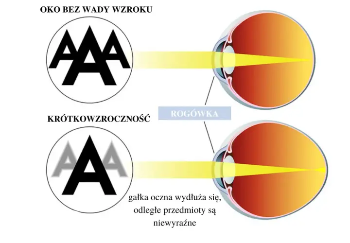 Oko z krótkowzrocznością: światło skupia się przed siatkówką, przez co odległe przedmioty są niewyraźne. Oko bez wady widzi ostro.