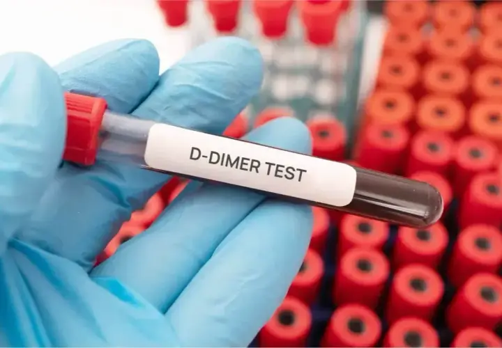 Rękawiczka w niebieskiej rękawiczce trzyma probówkę z napisem "D-DIMER TEST". Badanie to może pomóc ocenić d-dimery a stan zapalny.