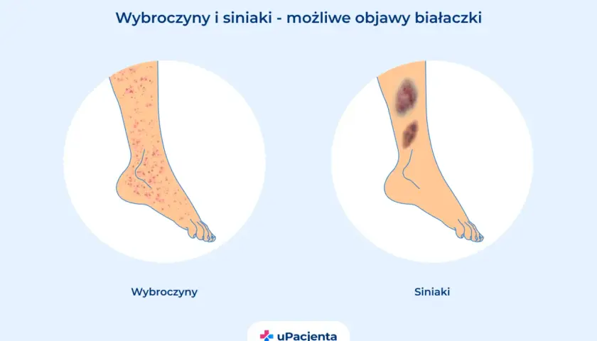 Wybroczyny i siniaki na nogach mogą być objawami białaczki. Ilustracja pokazuje zmiany skórne.