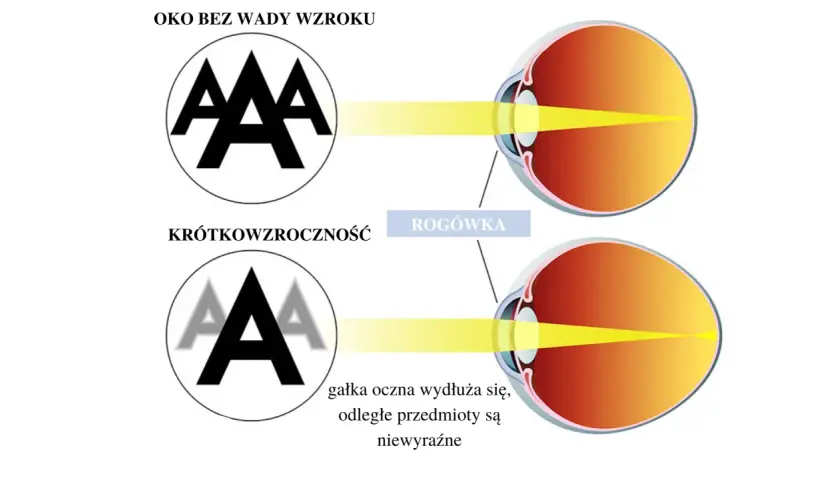 Oko z krótkowzrocznością: światło skupia się przed siatkówką, przez co odległe przedmioty są niewyraźne. Oko bez wady widzi ostro.