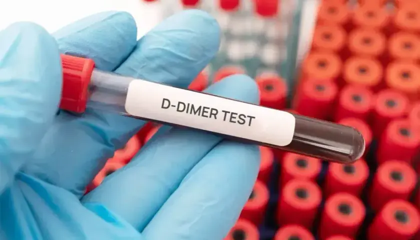Rękawiczka w niebieskiej rękawiczce trzyma probówkę z napisem "D-DIMER TEST". Badanie to może pomóc ocenić d-dimery a stan zapalny.