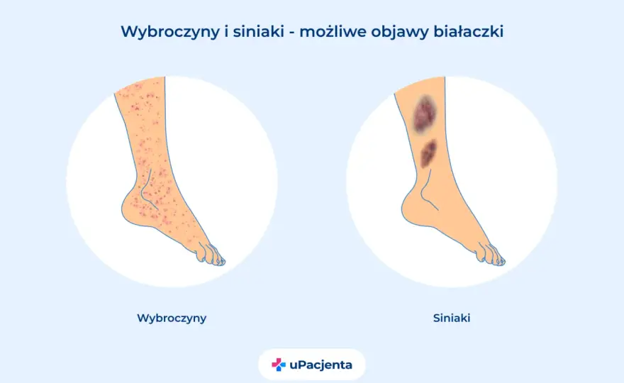 Objawy białaczki - Czy to tylko zmęczenie? Sprawdź!