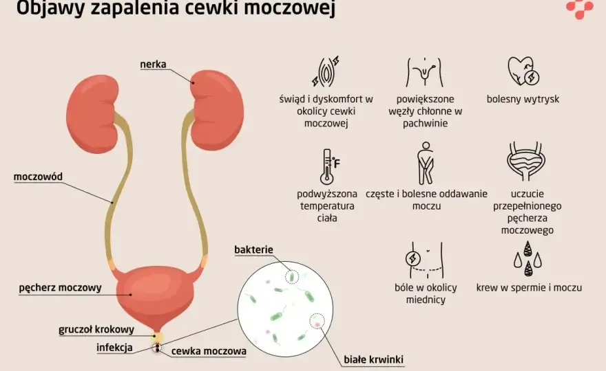 Zapalenie cewki moczowej - Czy to zawsze STI? Sprawdź objawy!