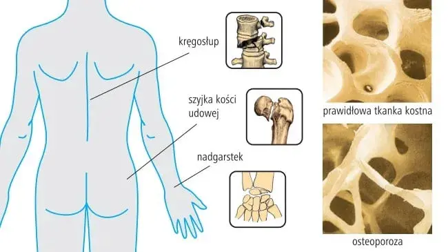 Osteoporoza jakie badania krwi są kluczowe dla diagnozy i zdrowia?